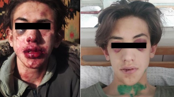 FOTO // Adolescent de 15 ani din Glodeni, snopit în bătaie de un tânăr de 19 ani. „Mi-a scos unghia cu dinții”