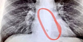 FOTO // Descoperire tulburătoare făcută de medici la un bărbat care suferea de un „gât uscat”
