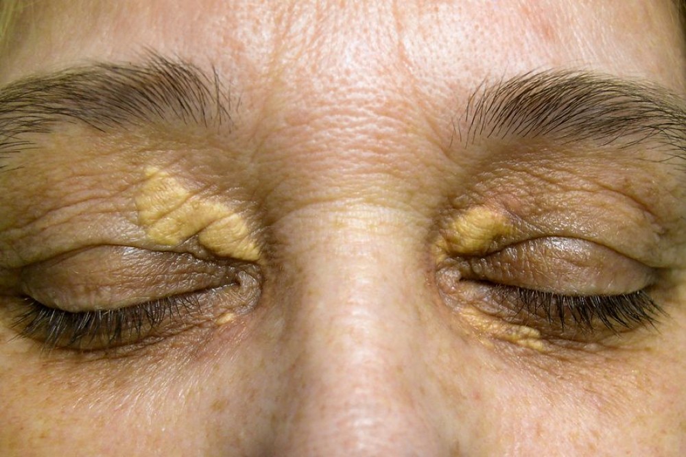 Semne pe piele de la ficat – cum se manifestă bolile hepatice la nivel dermatologic