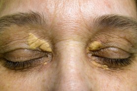 Semne pe piele de la ficat – cum se manifestă bolile hepatice la nivel dermatologic