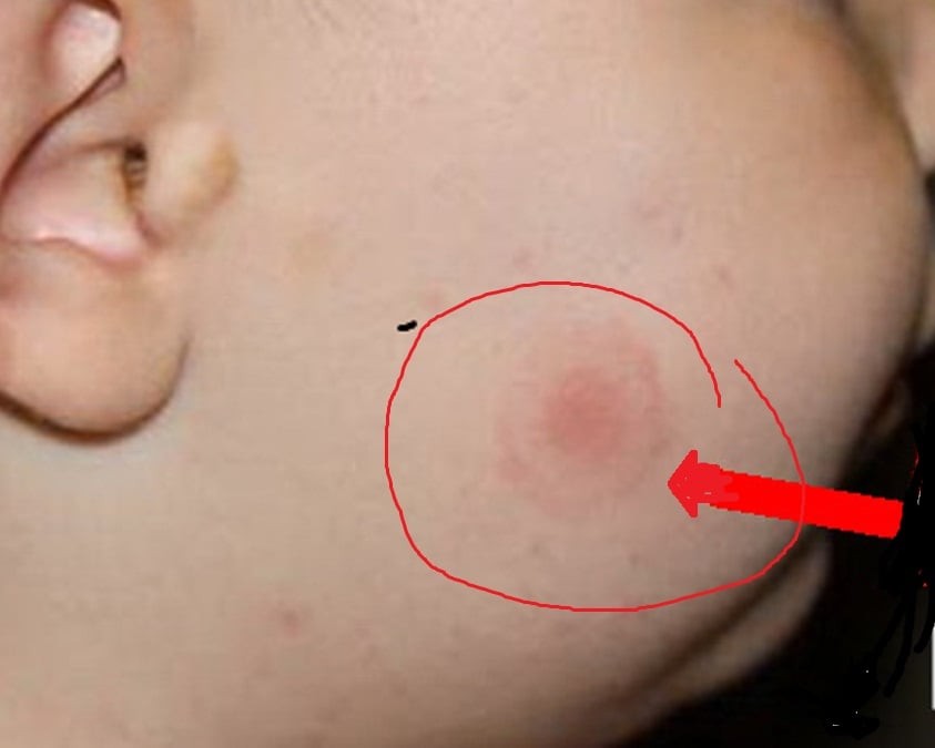 Ce să faci dacă te mușcă o căpușă. Semnele care trebuie să te trimită urgent la medic