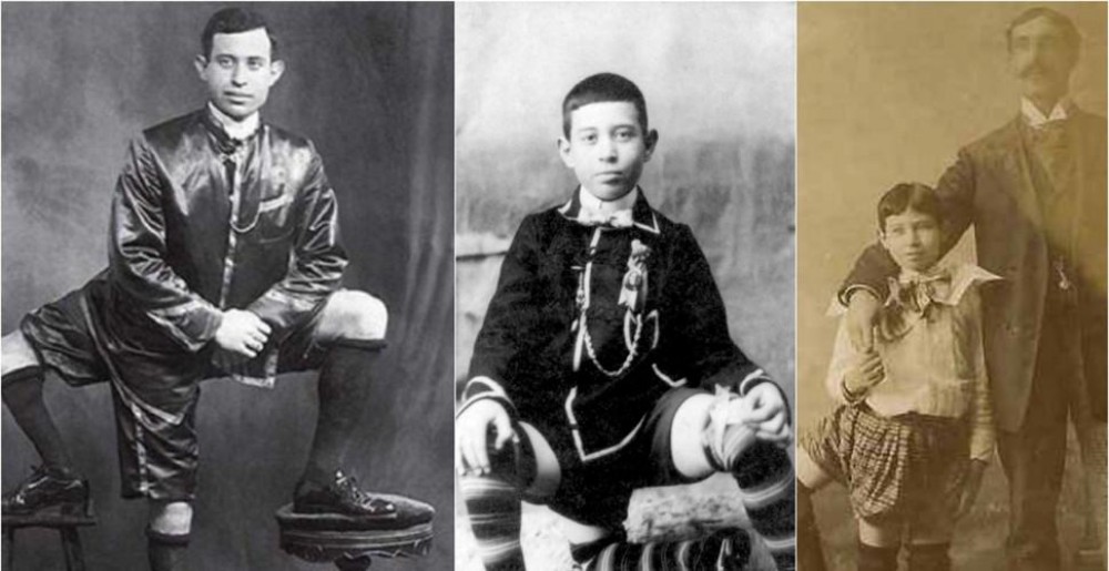 FOTO // 5 oameni care au intrat în istorie cu aspectul lor neobișnuit. Aceste cazuri au uimit lumea medicală