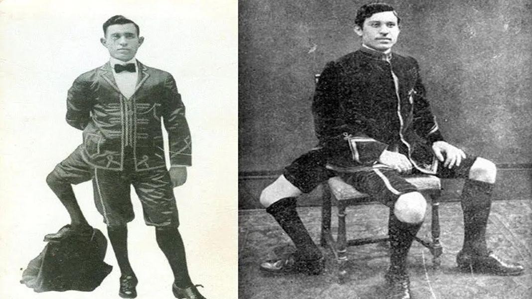 FOTO // 5 oameni care au intrat în istorie cu aspectul lor neobișnuit. Aceste cazuri au uimit lumea medicală