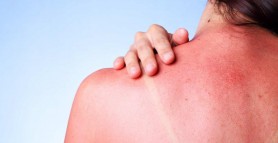 9 remedii pentru arsuri solare. Cel mai simplu mod prin care te poți trata chiar la tine acasă