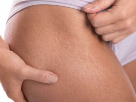 Ingredientul care te ajută să scapi de vergeturi