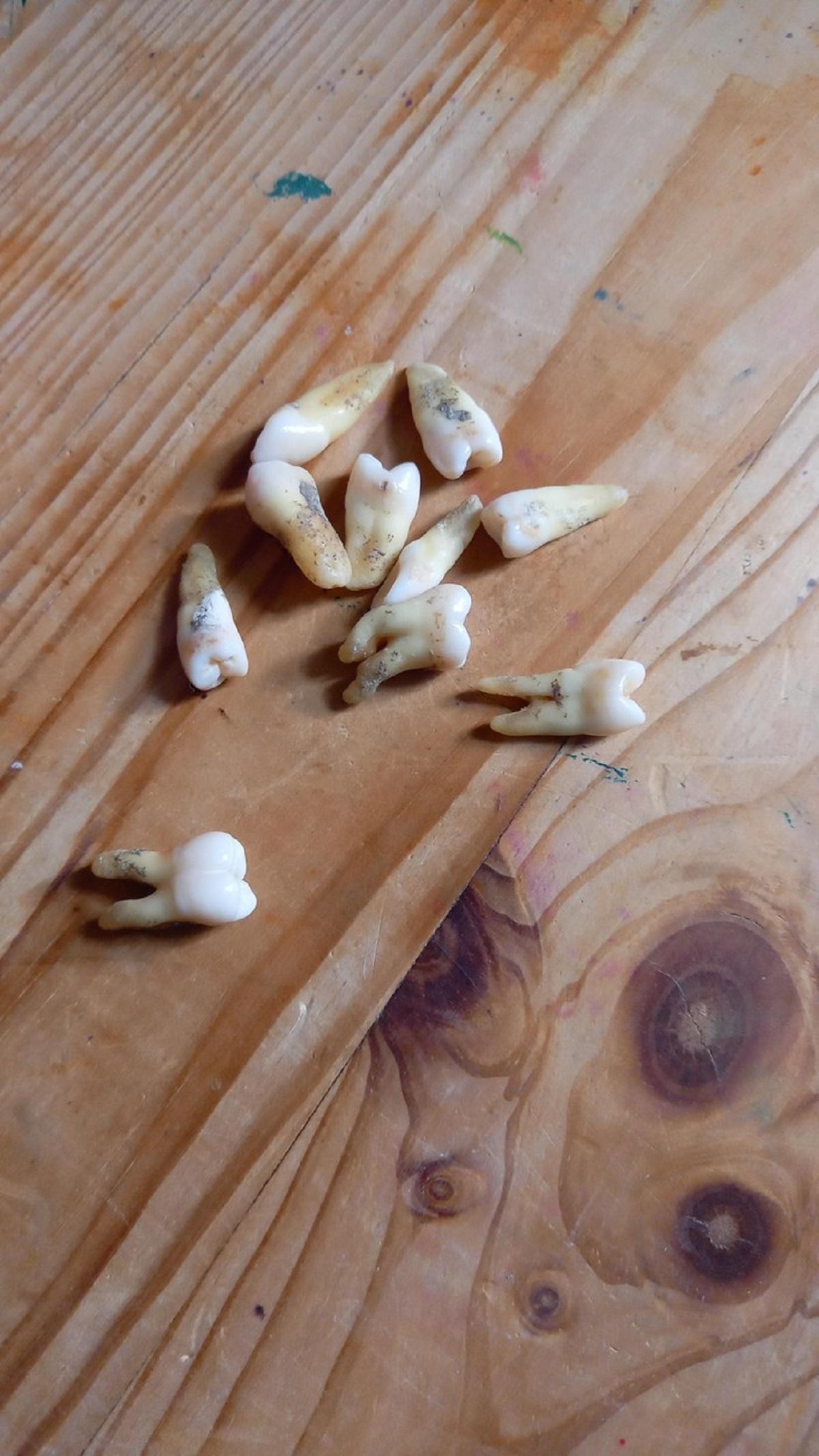 FOTO // O mamă şi-a scos singură 11 dinţi, pentru că nu avea bani să meargă la un dentist