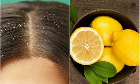 4 remedii naturale ca să scapi rapid de mătreaţă