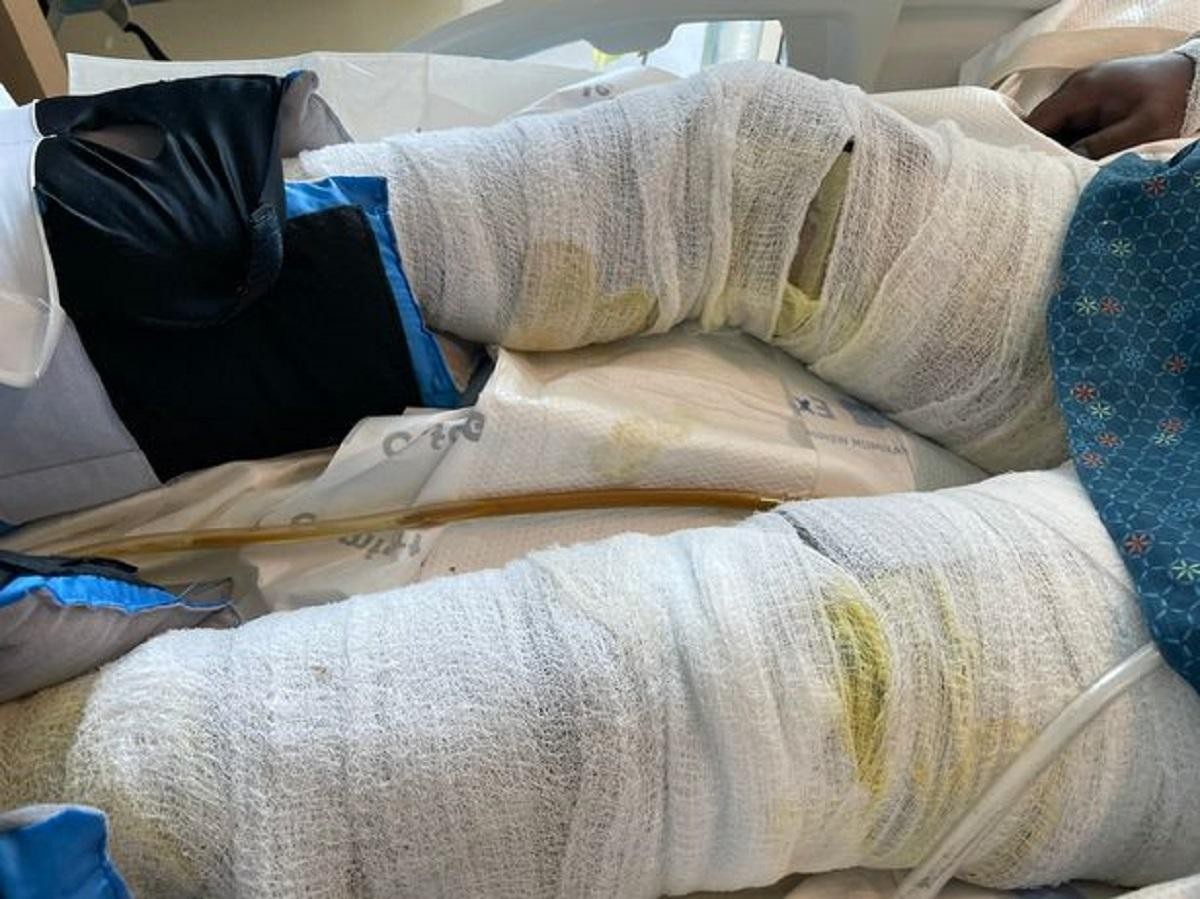 FOTO // O mamă a trei copii şi-a pierdut mâinile şi picioarele în urma unor complicaţii provocate de Covid-19