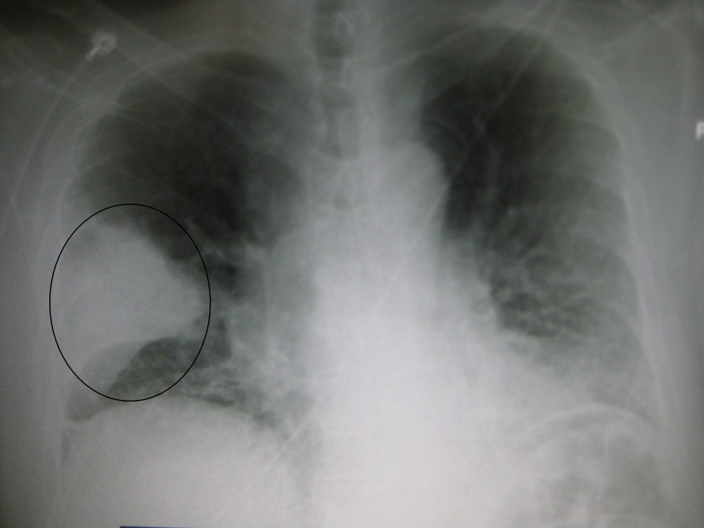 Simptome de pneumonie. Cine e la risc să aibă probleme cu plămânii