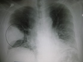 Simptome de pneumonie. Cine e la risc să aibă probleme cu plămânii