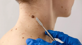 Ce se întâmplă dacă rupi sau tai o aluniță acasă. Poți face cancer? La ce pericole majore te expui