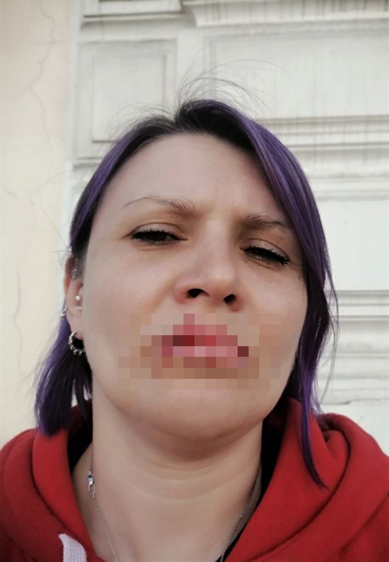 FOTO // O activistă rusă şi-a cusut gura în semn de protest faţă de războiul din Ucraina