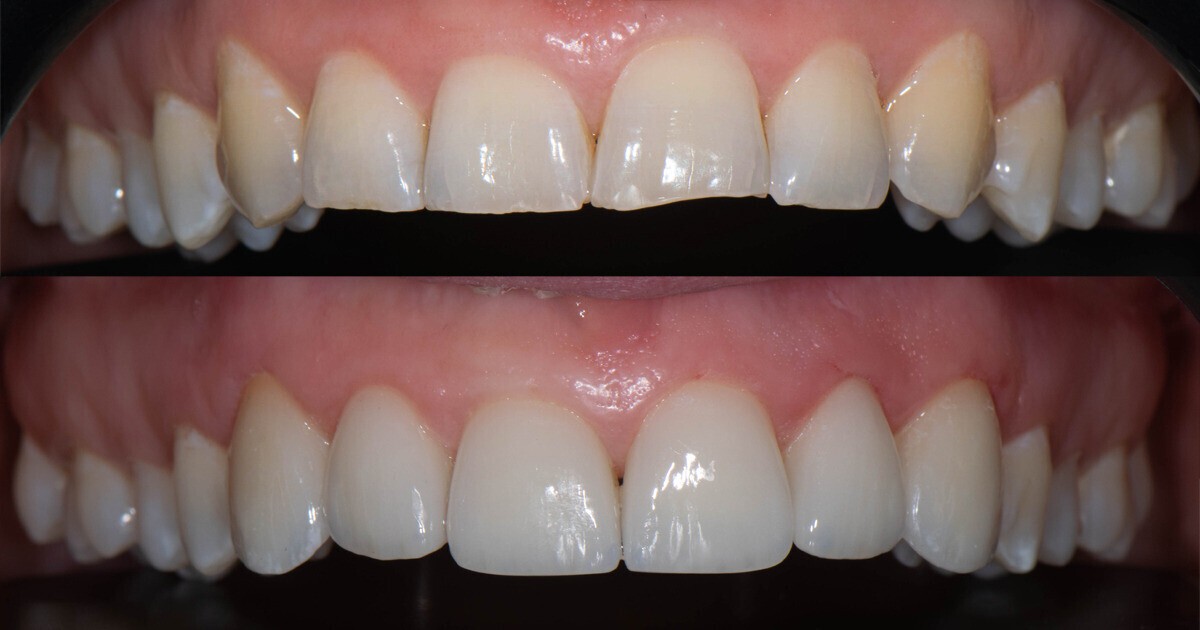 Îți dorești un zâmbet mai alb? Optează pentru albirea dentară profesională