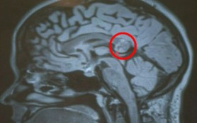 Descoperire uimitoare! Dieta care poate limita dezvoltarea tumorilor
