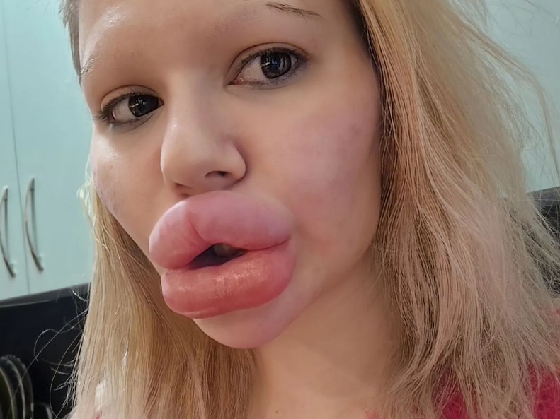 FOTO // Ea este femeia cu cele mai mari buze din lume. Are peste 40 de intervenții