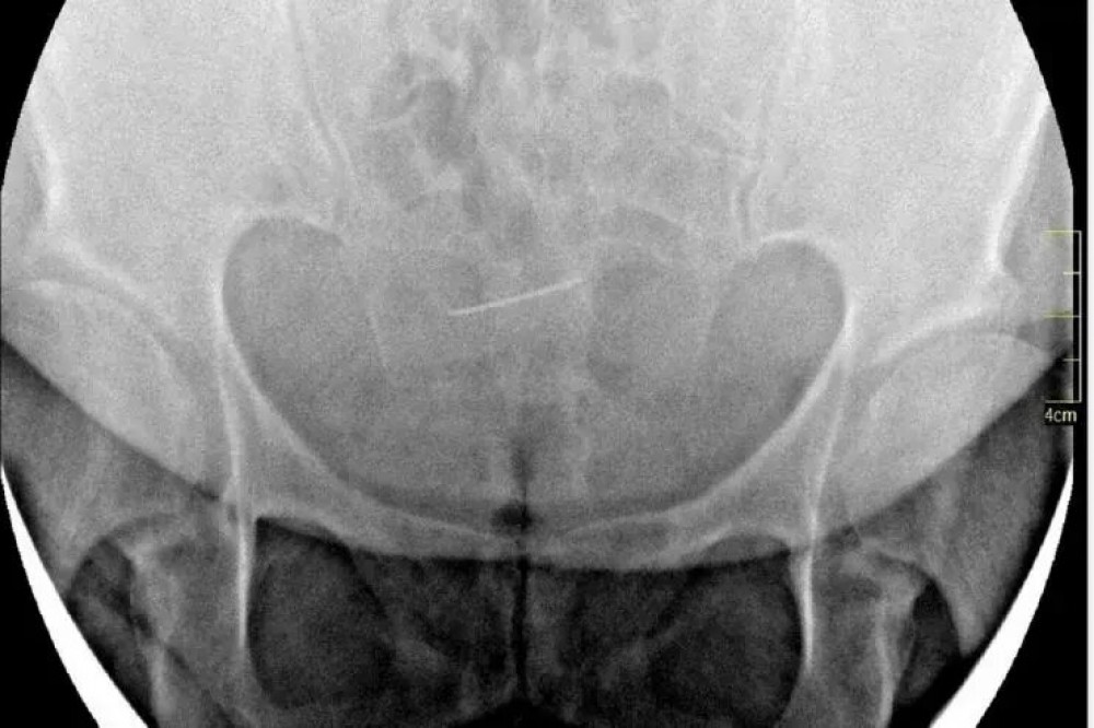 O femeie din Iași a trăit 30 de ani cu un ac în abdomen. S-a prezentat la medic după ce a început să se simtă rău